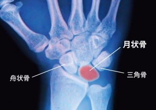 キーンベック病の月状骨