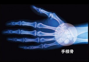 手首の骨折