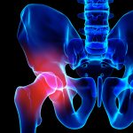 股関節痛を解消する筋膜リリース