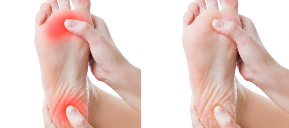 足底腱膜炎を緩和する筋膜リリース