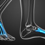 【フライバーグ病】足指の付け根が痛い骨端症の治療と予防