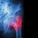 【ペルテス病】股関節の骨端症の治療と予防法！